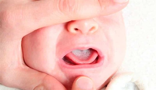Молочница у новорожденных лечение