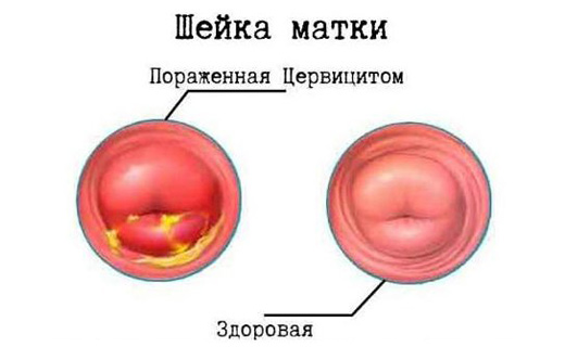 гнойный
