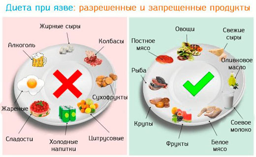диета при язве желудка