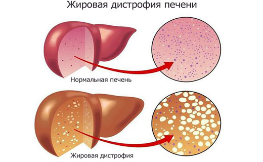 жировое перерождение печени