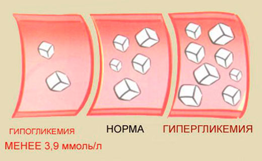 гипогликемия