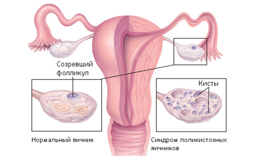поликестоз