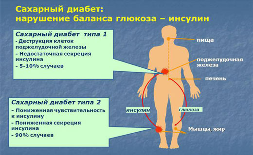 инсулин и диабет