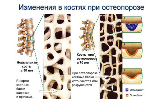 остеопороз
