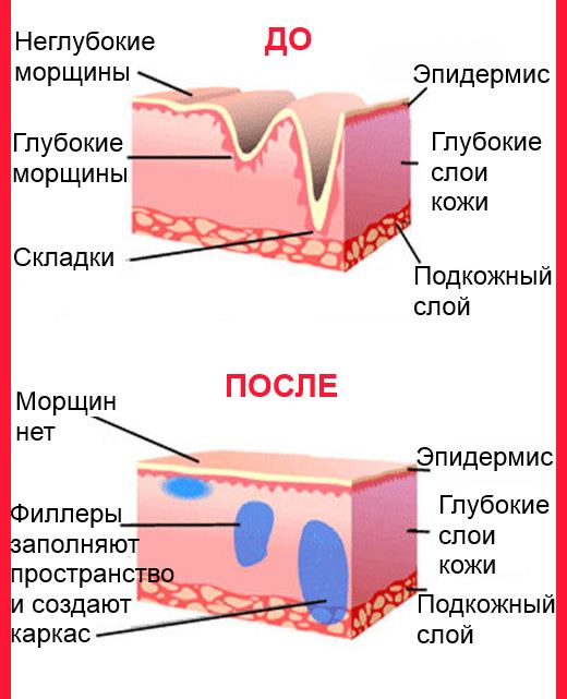 Как работают филлеры после контурной пластики