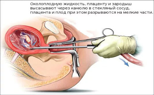 аборт