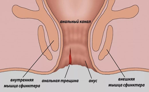 анальное кровотечение