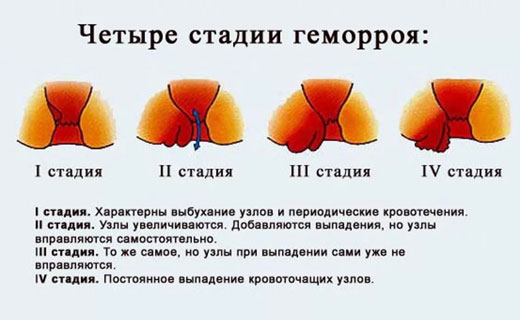 геморрой