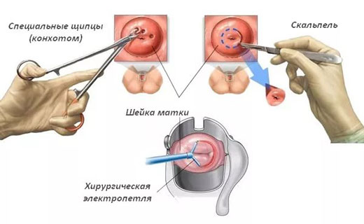 биопсия шейки матки