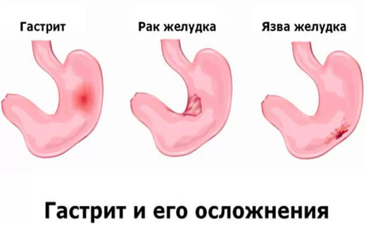 гастрит и его осложнения