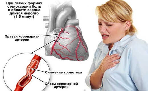 стенокардия