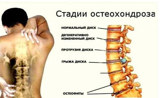 остеохандроз