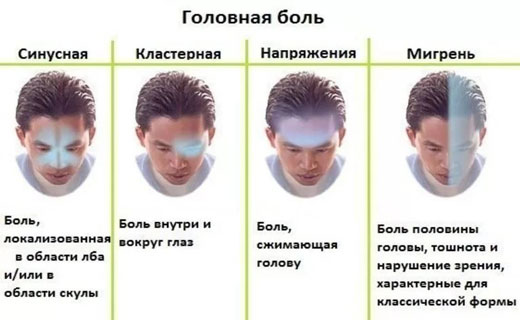виды головных болей