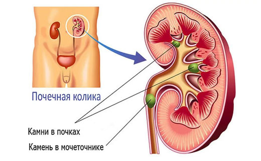 почечная колика