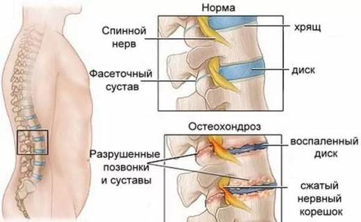 остеохагдроз позвонолчника