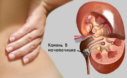 почечные колики