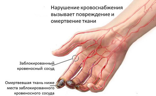 атеросклероз