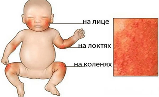сыпь