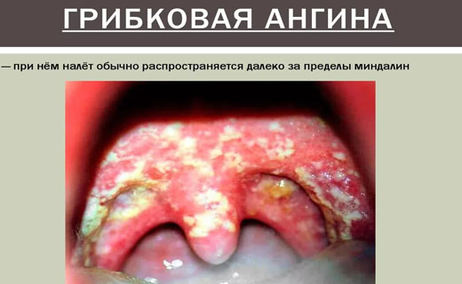ангина лечение
