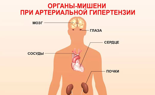 артериальная гепиртензия