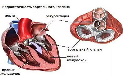 недостаточность