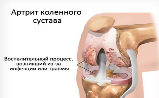 бады и витамины при артрите