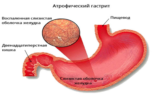 Атрофический Гастрит Диета Что Можно