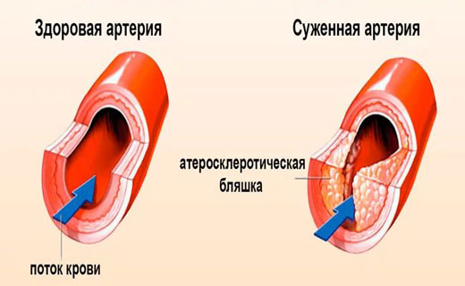 атеросклероз