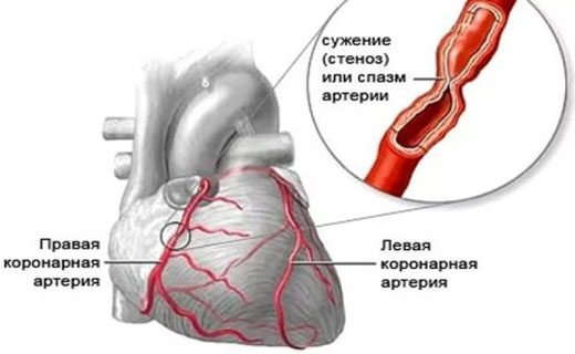 атеросклероз