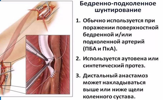 атеросклероз