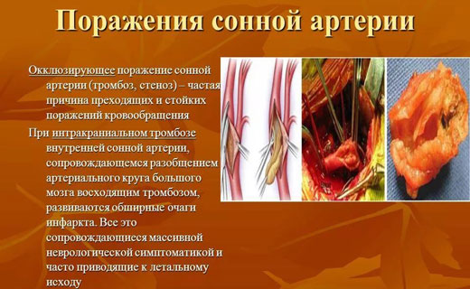 атеросклероз