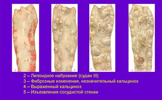 атеросклероз