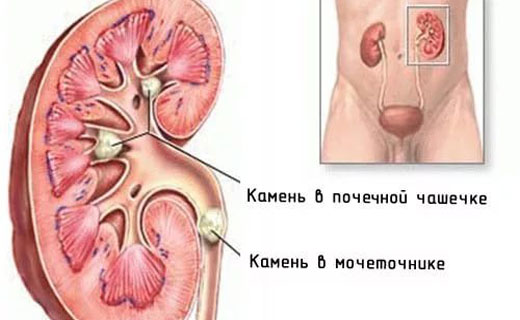 почки