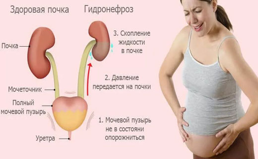 почки