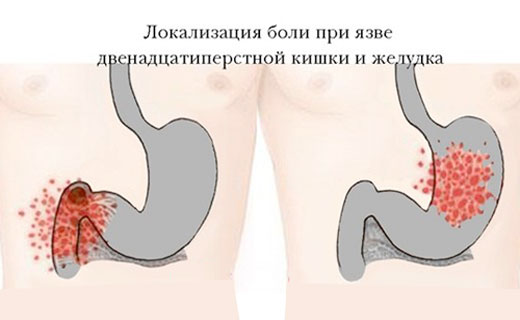 боль при язве желудка