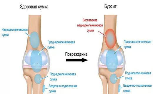 сустав бурсит
