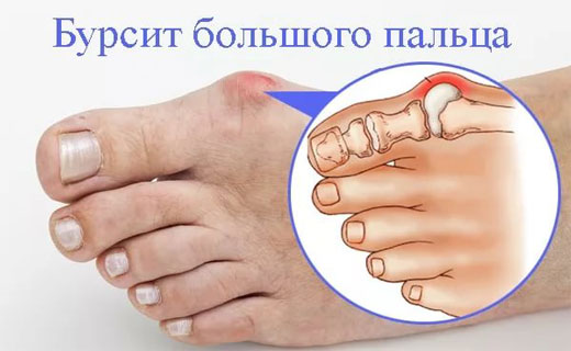 бурсит