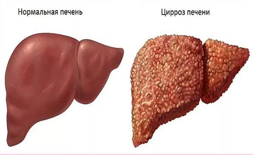 цирроз печени
