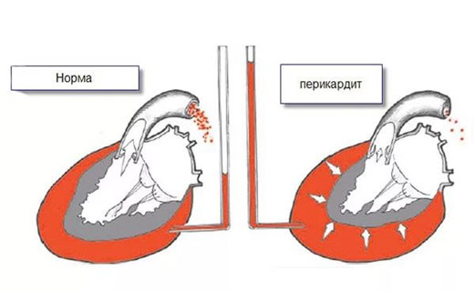 болезни сердца
