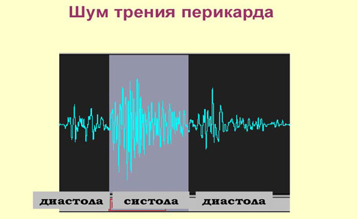 болезни сердца