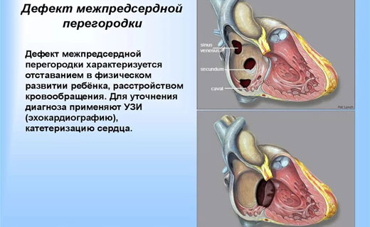 болезнь сердца
