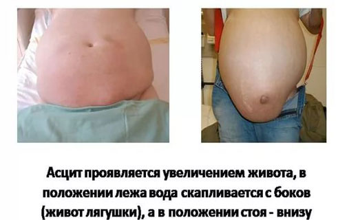 желтуха
