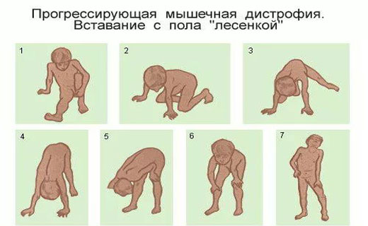мышечная дистрофия