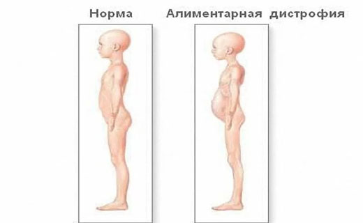 дистрофия тела