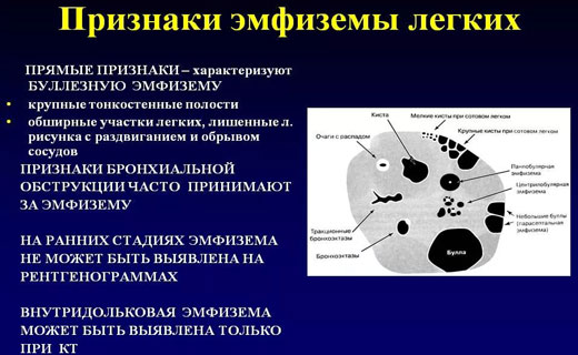 эмфизема