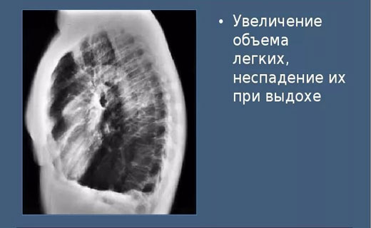 эмфизема