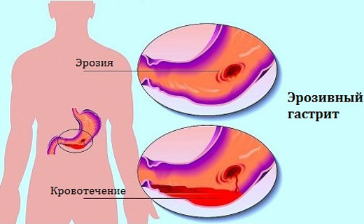 симптомы геморрагического гастрита