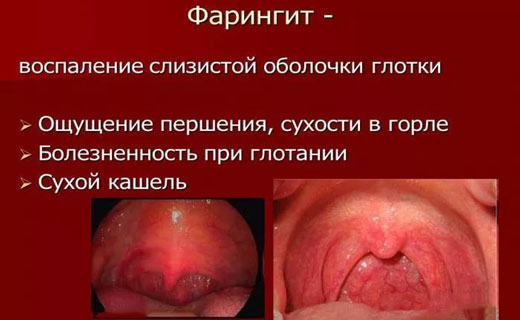 фарингит