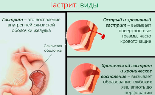 боли в желудке