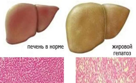 Жировая Болезнь Печени Диета